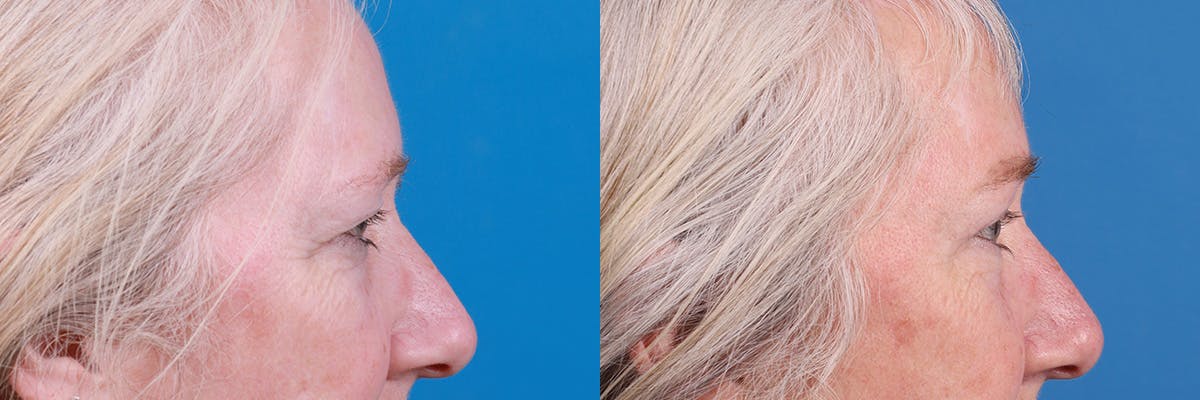 Brow Lift Before & After Gallery - Patient 103374 - Image 3