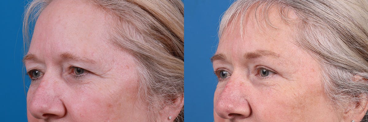 Eyelid Surgery Before & After Gallery - Patient 195870 - Image 4