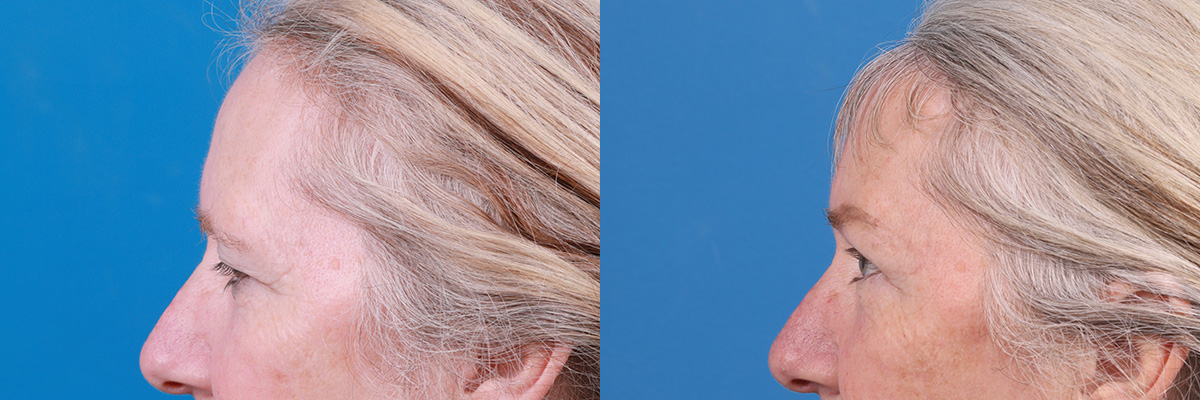 Brow Lift Before & After Gallery - Patient 103374 - Image 5