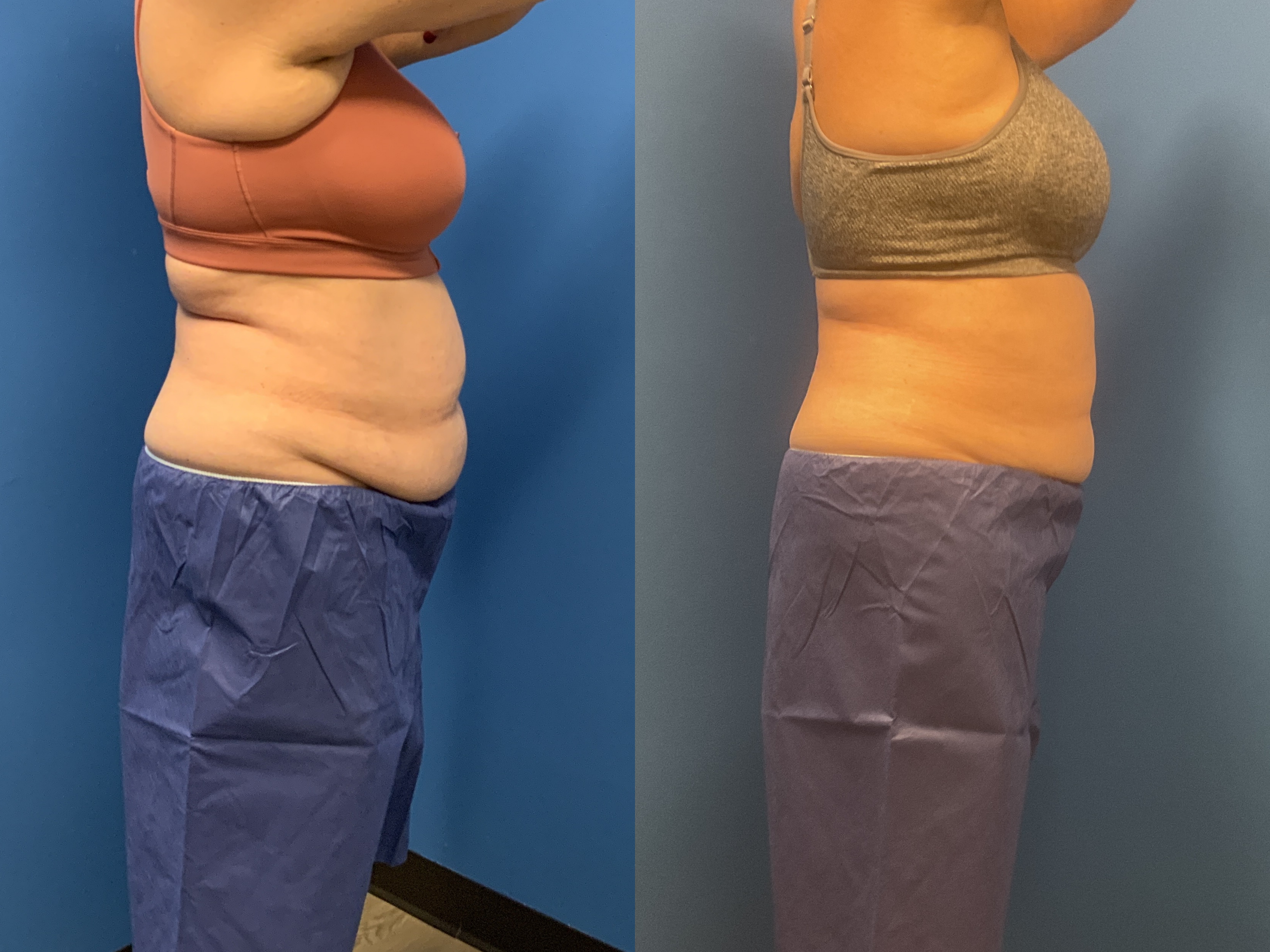 CoolSculpting Before & After Gallery - Patient 211337 - Image 2