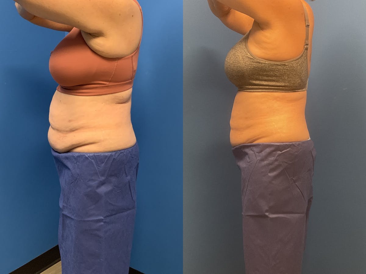 CoolSculpting Before & After Gallery - Patient 147406 - Image 3
