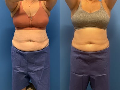 CoolSculpting Before & After Gallery - Patient 147406 - Image 1