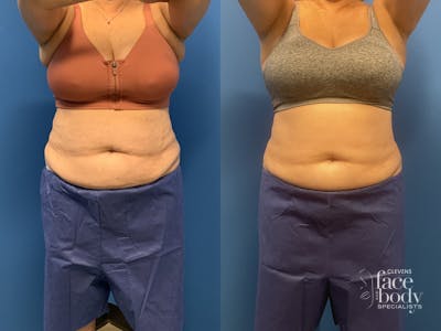 CoolSculpting Before & After Gallery - Patient 211337 - Image 1