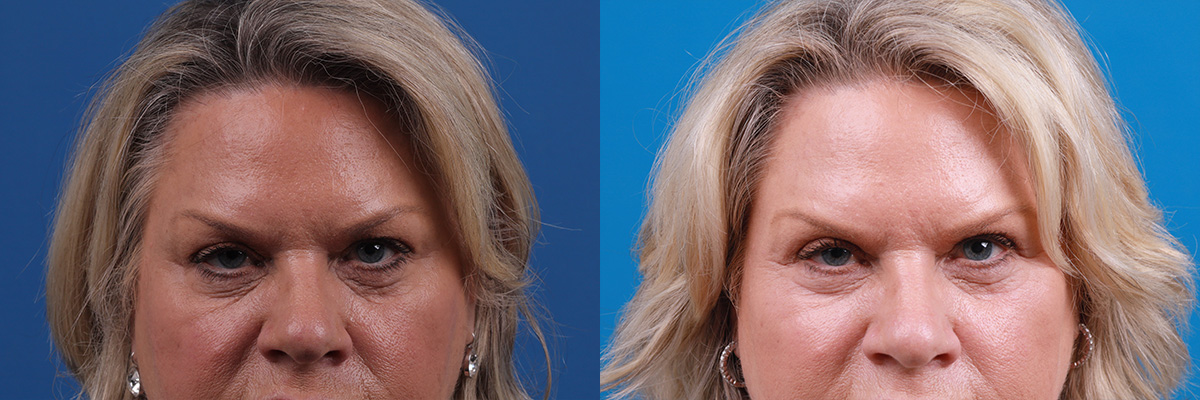 Eyelid Surgery Before & After Gallery - Patient 146532 - Image 1