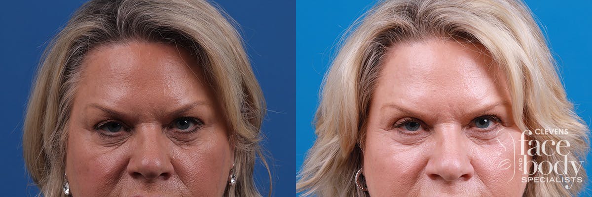 Eyelid Surgery Before & After Gallery - Patient 146532 - Image 1