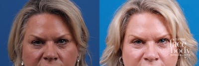 Eyelid Surgery Before & After Gallery - Patient 146532 - Image 1