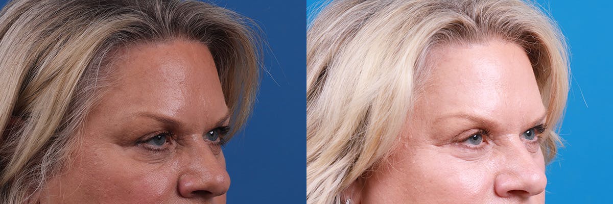 Eyelid Surgery Before & After Gallery - Patient 306005 - Image 2