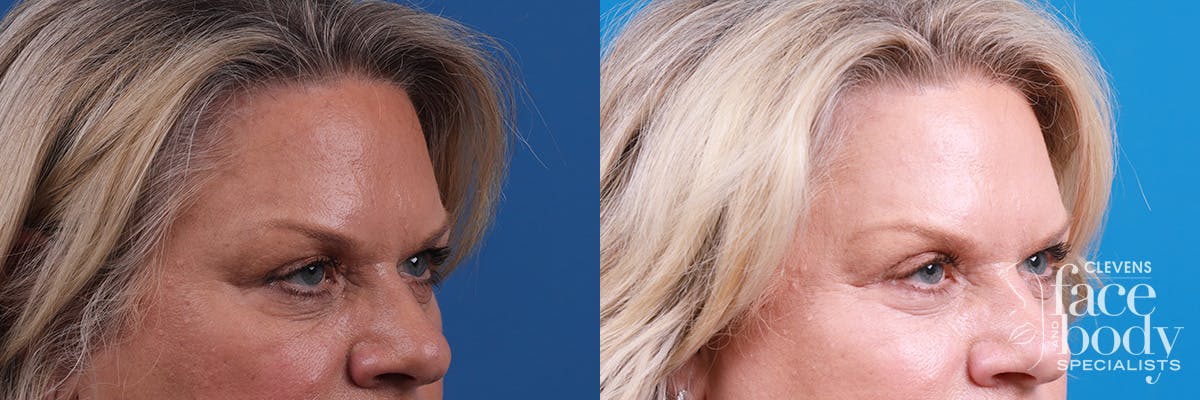 Eyelid Surgery Before & After Gallery - Patient 146532 - Image 2