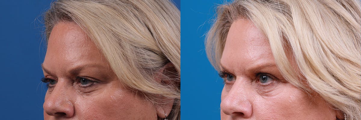 Eyelid Surgery Before & After Gallery - Patient 306005 - Image 3