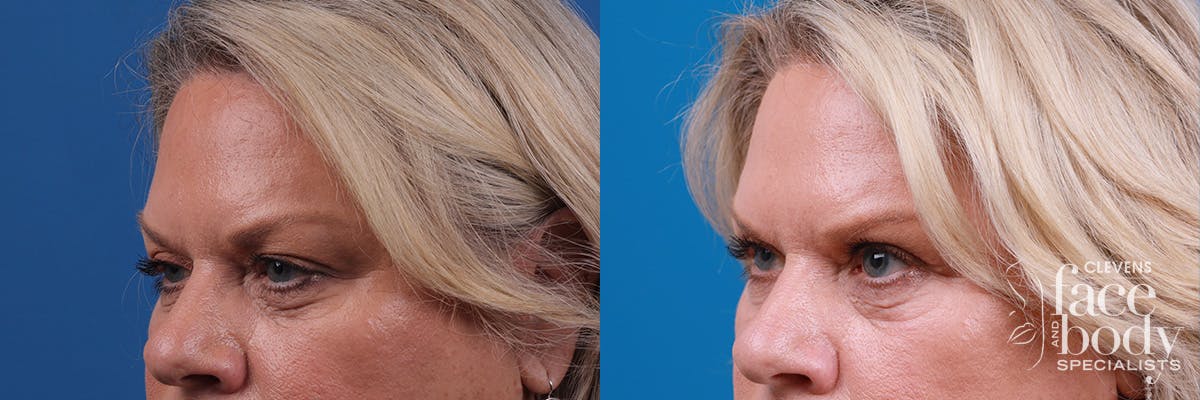 Eyelid Surgery Before & After Gallery - Patient 146532 - Image 3
