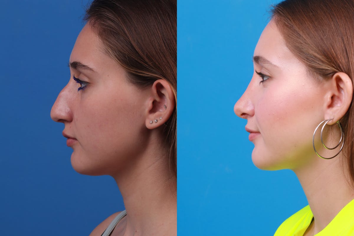 Rhinoplasty Before & After Gallery - Patient 387207 - Image 5