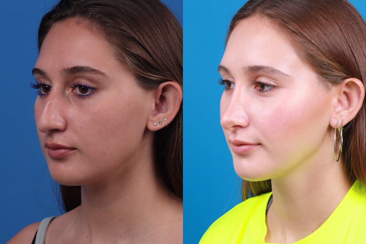 Rhinoplasty Before & After Gallery - Patient 387207 - Image 4