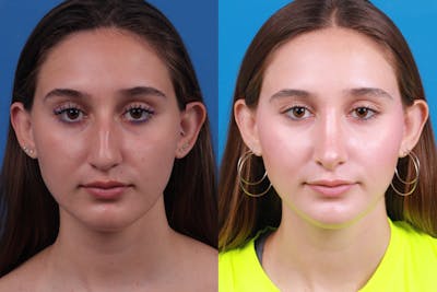 Rhinoplasty Before & After Gallery - Patient 387207 - Image 1