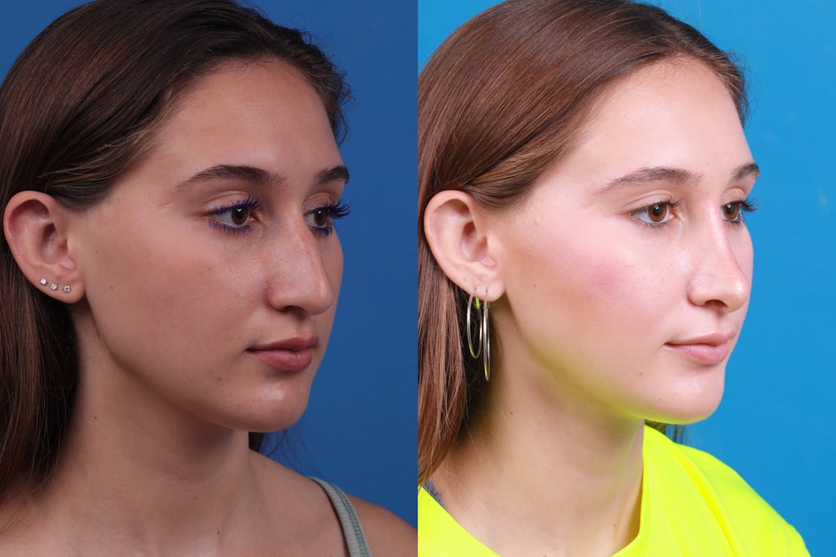 Rhinoplasty Before & After Gallery - Patient 387207 - Image 2