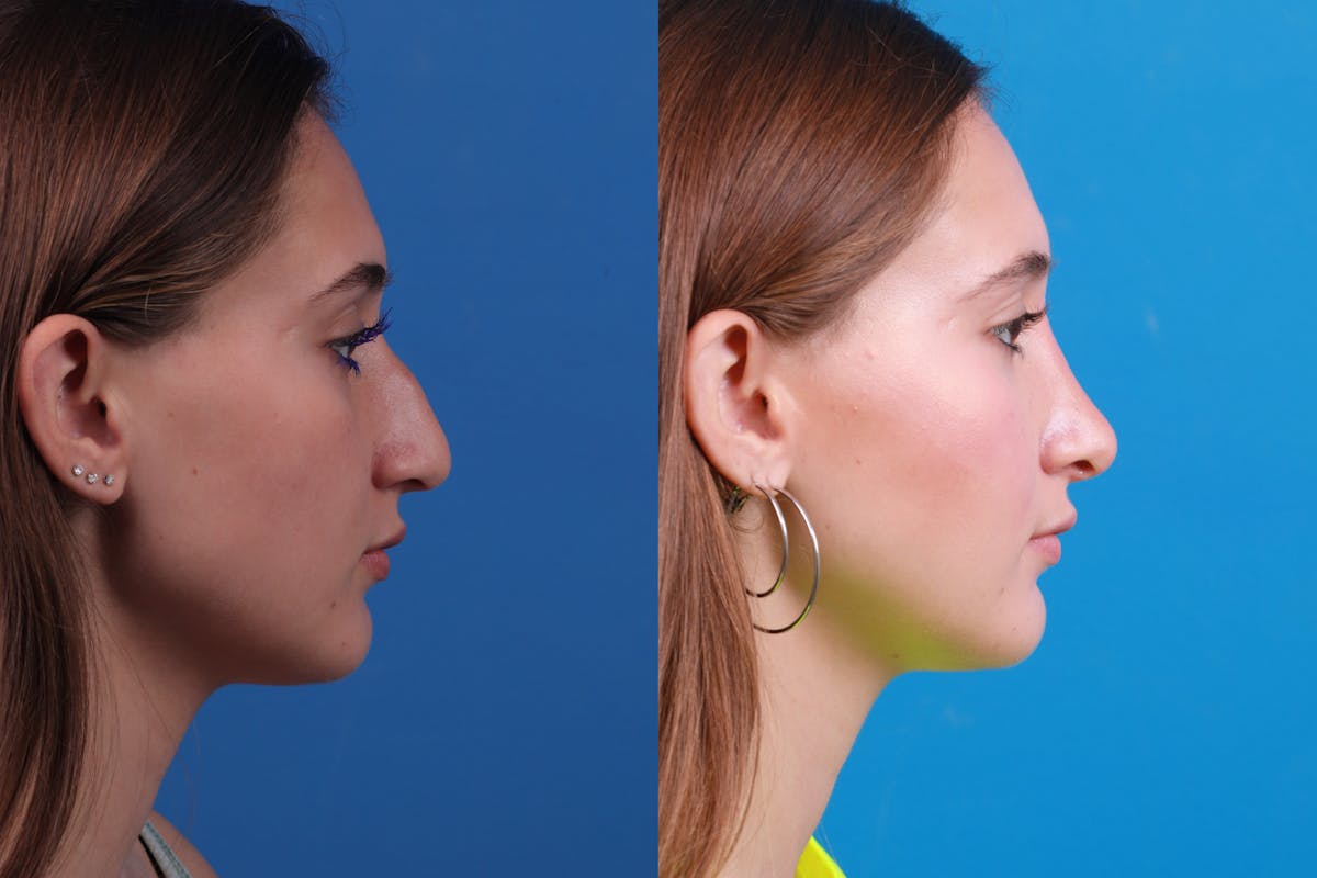 Rhinoplasty Before & After Gallery - Patient 387207 - Image 3