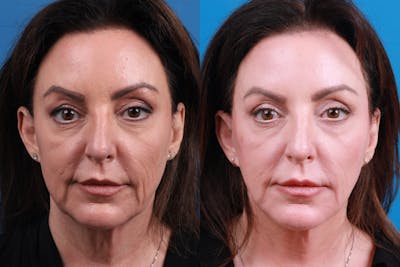Facelift Before & After Gallery - Patient 208780 - Image 1