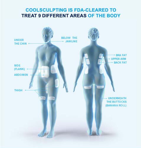 CoolSculpting infographic