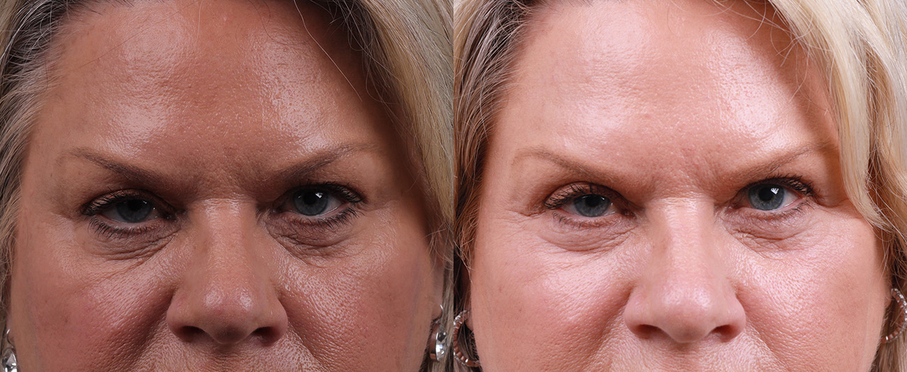 Skin Resurfacing Before & After Gallery - Patient 372278 - Image 1