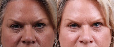 Skin Resurfacing Before & After Gallery - Patient 372278 - Image 1