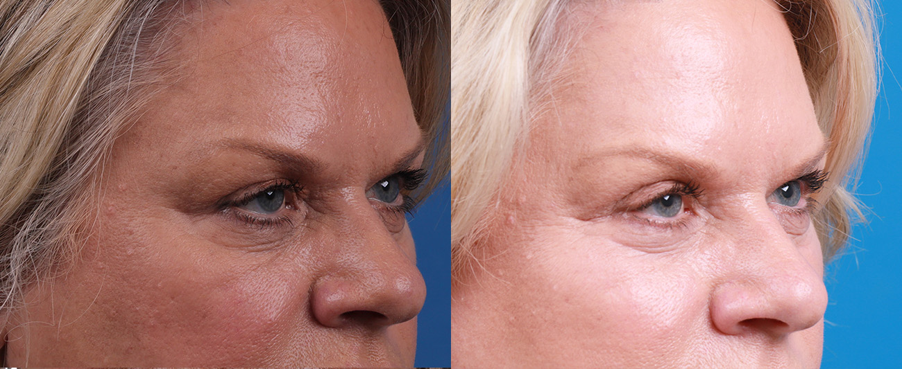 Skin Resurfacing Before & After Gallery - Patient 372278 - Image 2