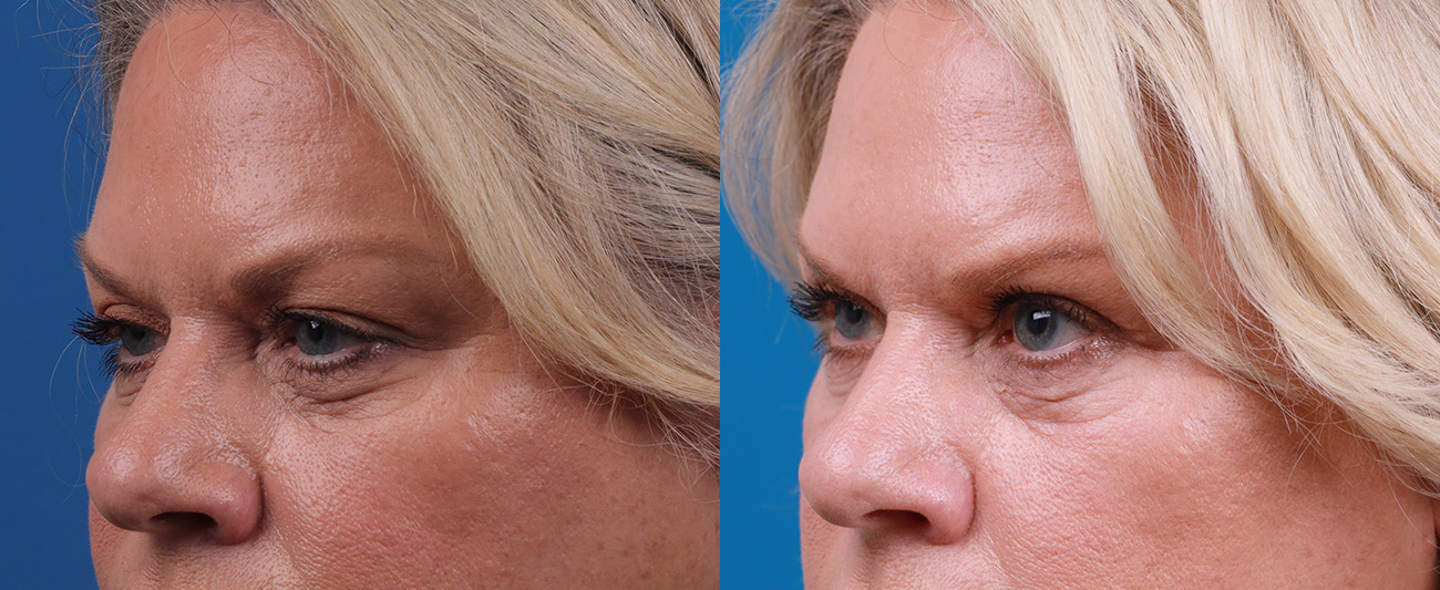 Skin Resurfacing Before & After Gallery - Patient 372278 - Image 3
