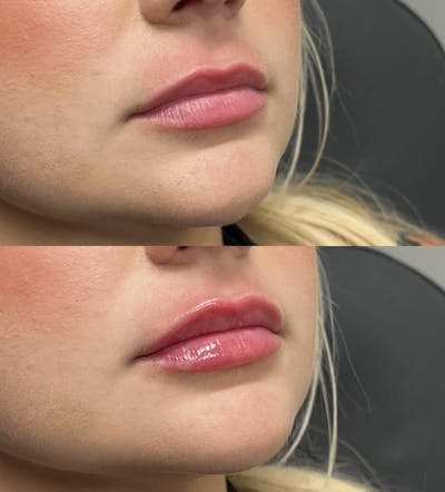Lip Fillers Before & After Gallery - Patient 213491 - Image 1