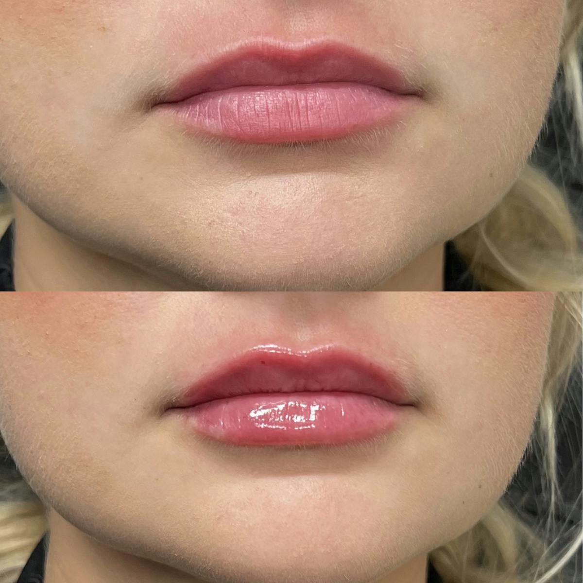 Lip Fillers Before & After Gallery - Patient 213491 - Image 2