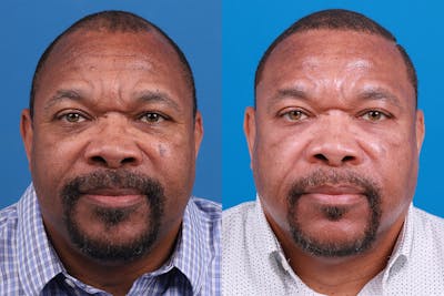 Hair Restoration Before & After Gallery - Patient 232040 - Image 1