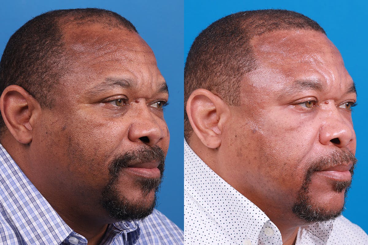 Hair Restoration Before & After Gallery - Patient 232040 - Image 2