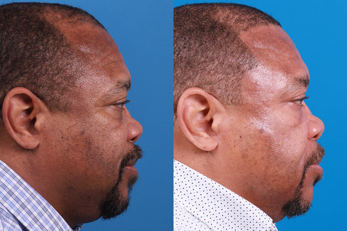 Hair Restoration Before & After Gallery - Patient 232040 - Image 3