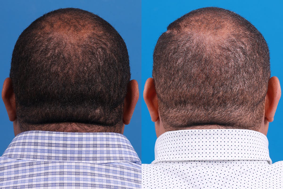 Hair Restoration Before & After Gallery - Patient 232040 - Image 4