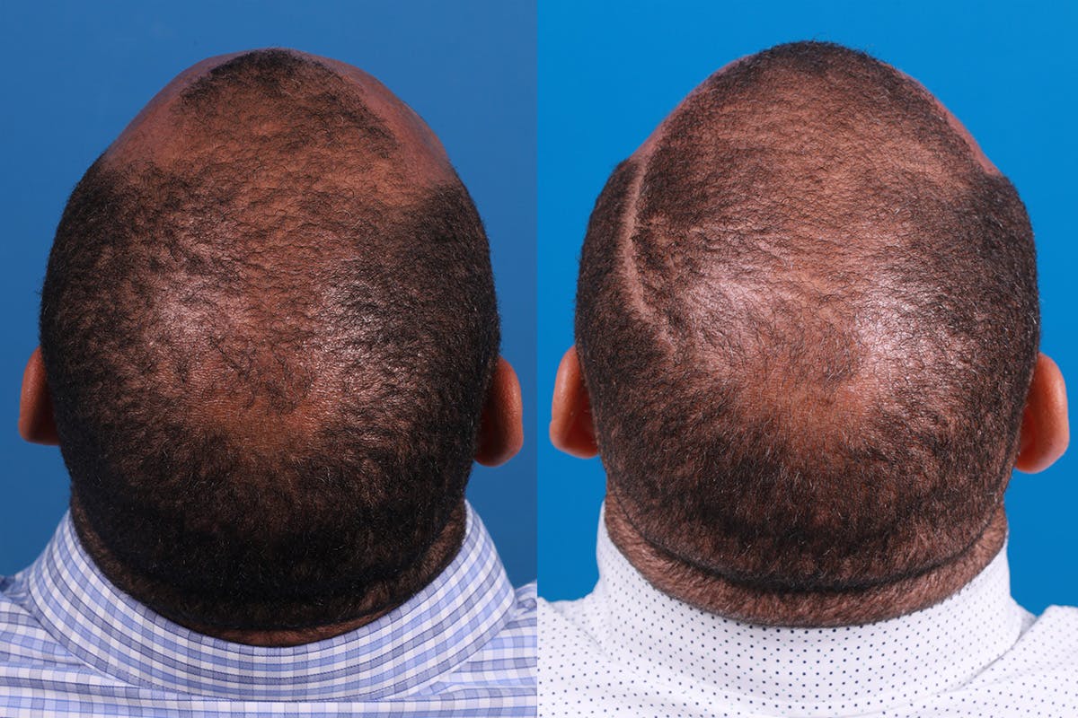 Hair Restoration Before & After Gallery - Patient 232040 - Image 5