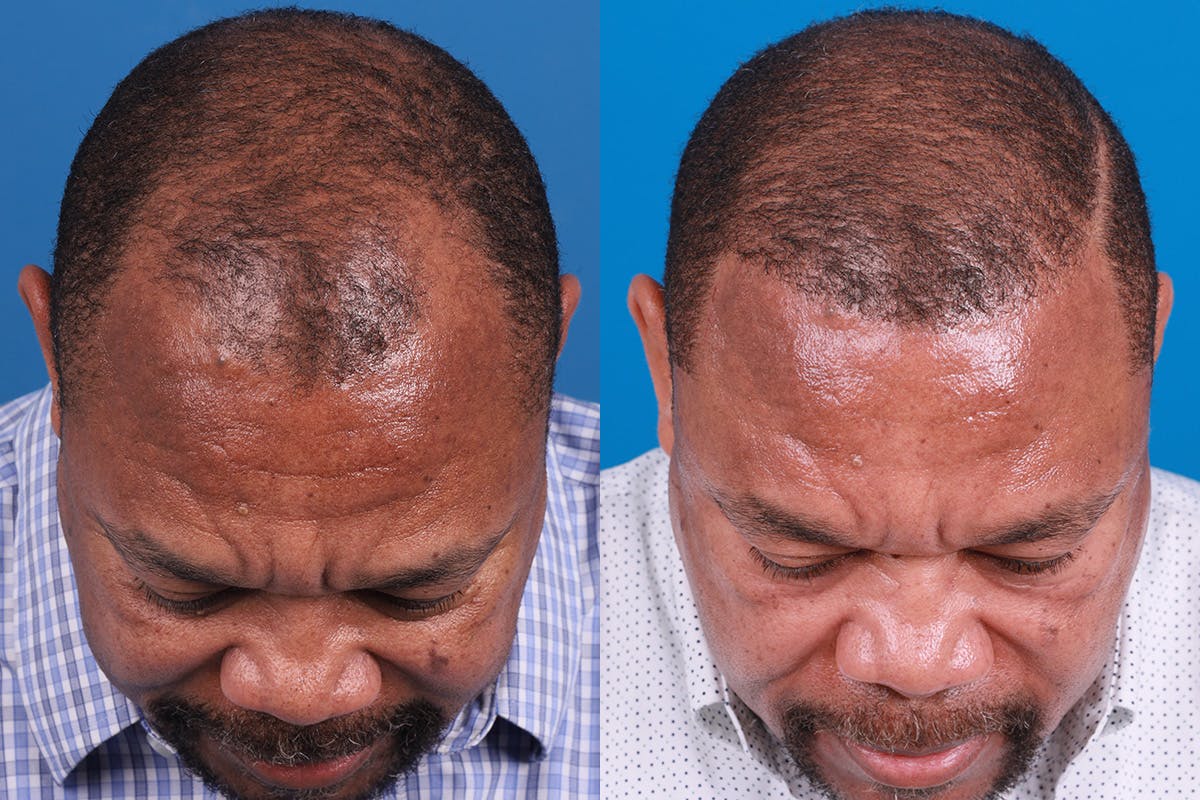 Hair Restoration Before & After Gallery - Patient 232040 - Image 6