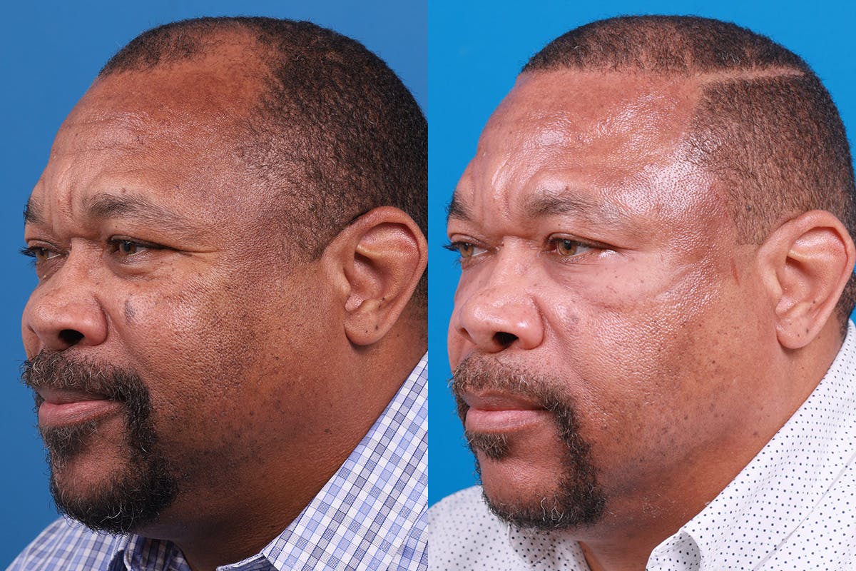 Hair Restoration Before & After Gallery - Patient 232040 - Image 7