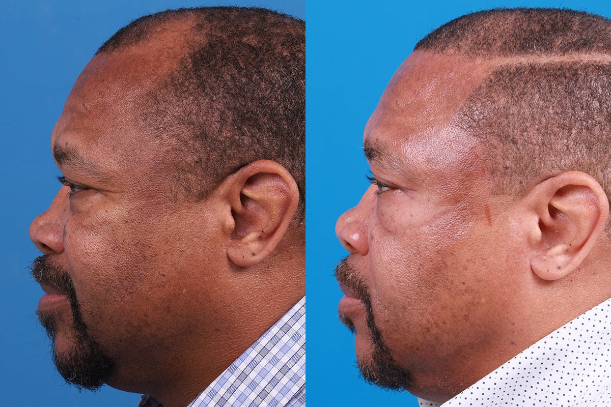 Hair Restoration Before & After Gallery - Patient 232040 - Image 8
