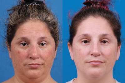 Rhinoplasty Before & After Gallery - Patient 389845 - Image 1