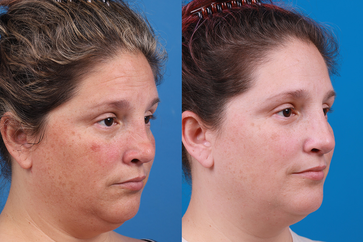 Rhinoplasty Before & After Gallery - Patient 389845 - Image 2