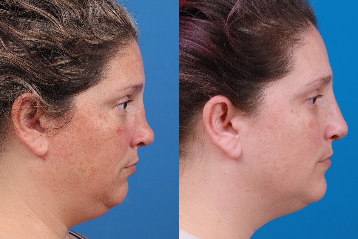 Rhinoplasty Before & After Gallery - Patient 389845 - Image 3