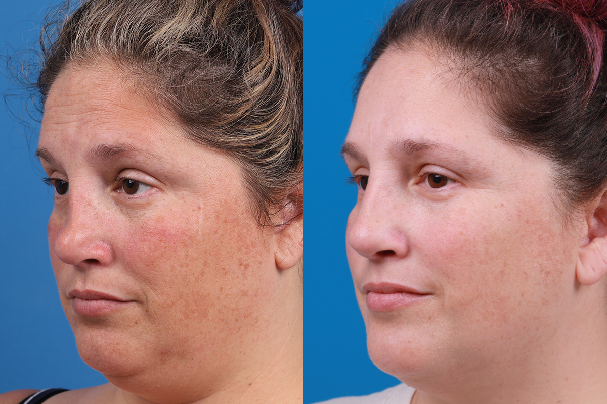 Rhinoplasty Before & After Gallery - Patient 389845 - Image 4