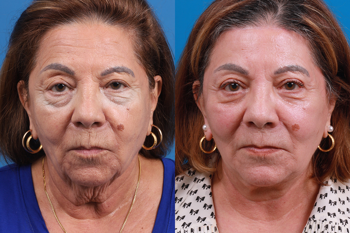 Nasolabial Folds Before & After Gallery - Patient 260418 - Image 1