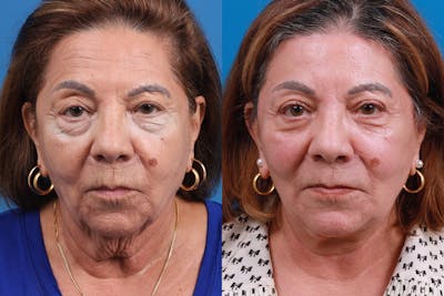 Brow Lift Before & After Gallery - Patient 200881 - Image 1
