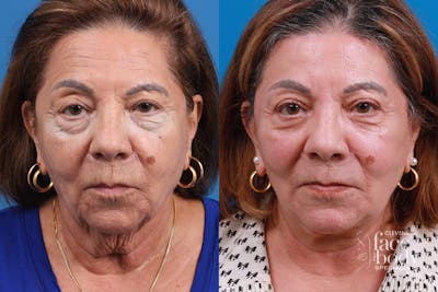 Eyelid Surgery Before & After Gallery - Patient 128781 - Image 1