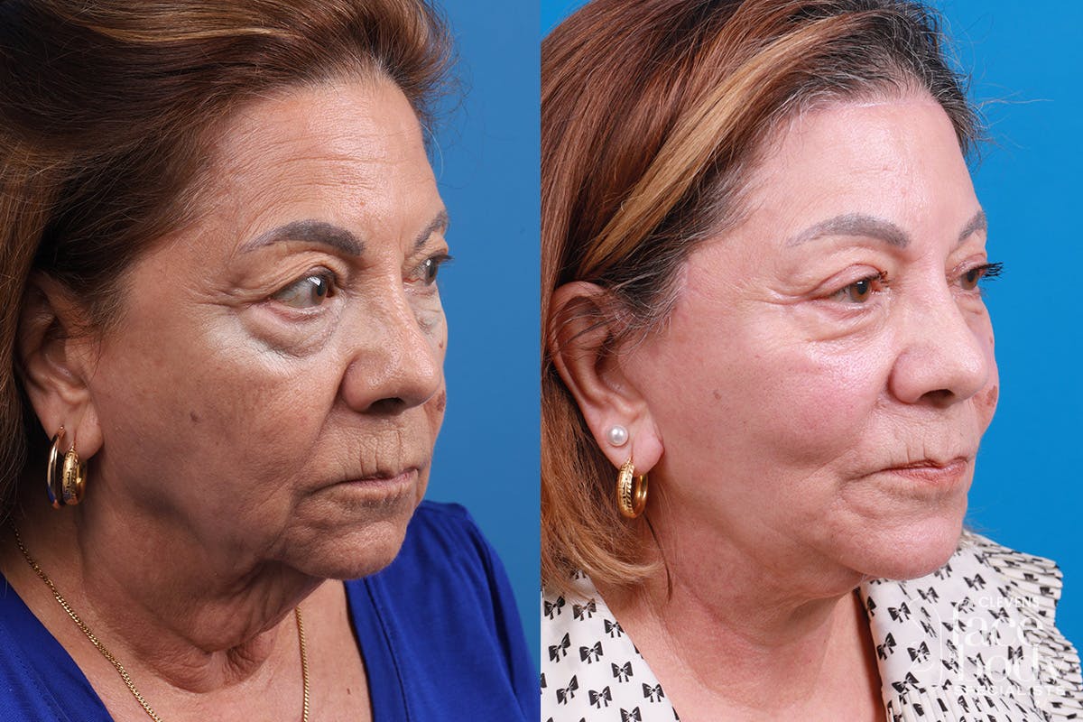 Eyelid Surgery Before & After Gallery - Patient 128781 - Image 2