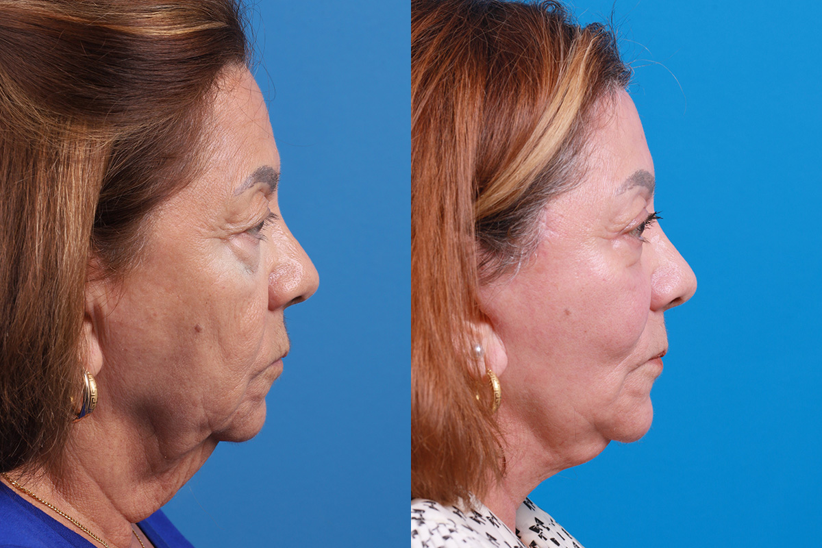 Eyelid Surgery Before & After Gallery - Patient 128781 - Image 3