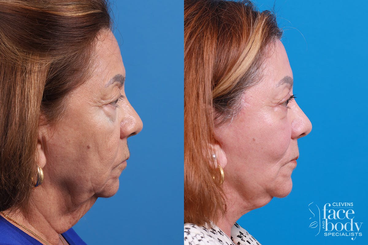 Eyelid Surgery Before & After Gallery - Patient 128781 - Image 3