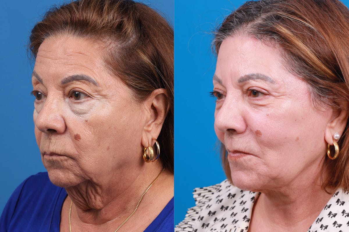 Nasolabial Folds Before & After Gallery - Patient 260418 - Image 4