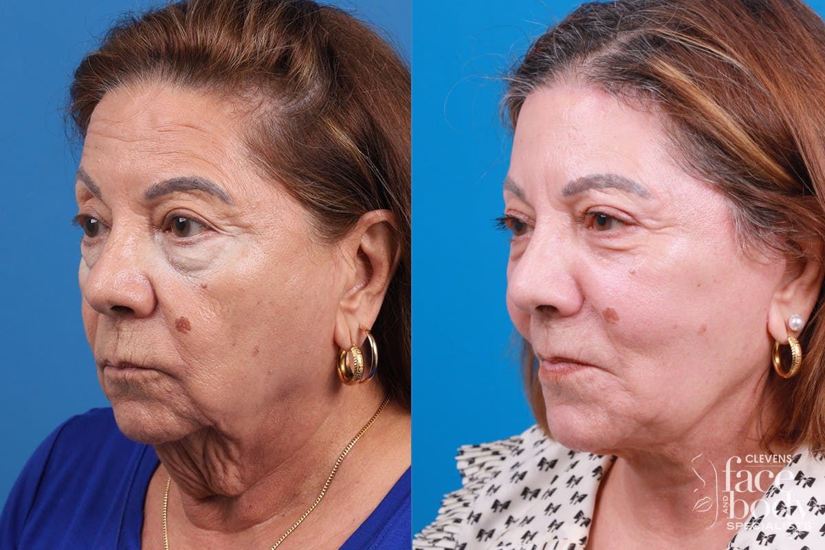 Eyelid Surgery Before & After Gallery - Patient 128781 - Image 4