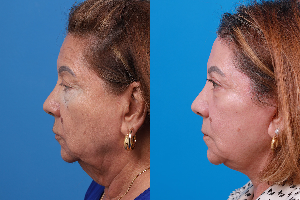Eyelid Surgery Before & After Gallery - Patient 128781 - Image 5