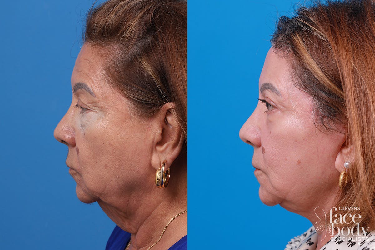 Eyelid Surgery Before & After Gallery - Patient 128781 - Image 5
