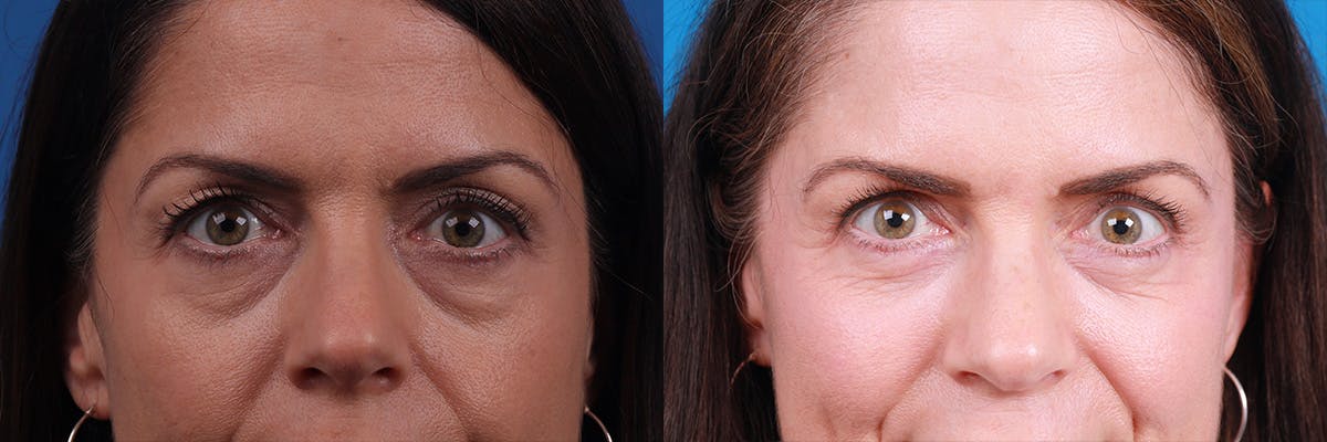 Eyelid Surgery Before & After Gallery - Patient 295029 - Image 1